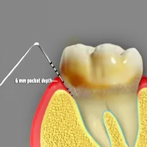 Dental Prophylaxis Dental Prophylaxis